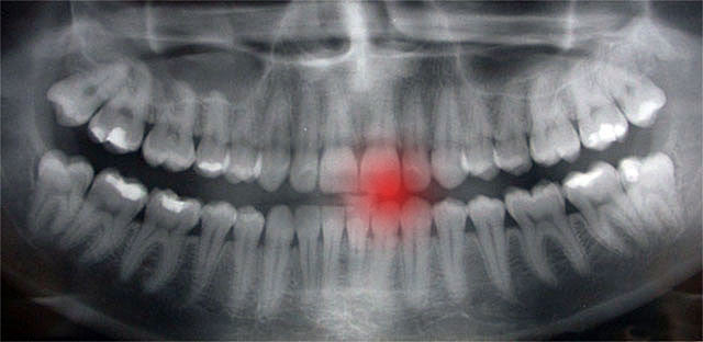 The Untold Effects of Nail Biting